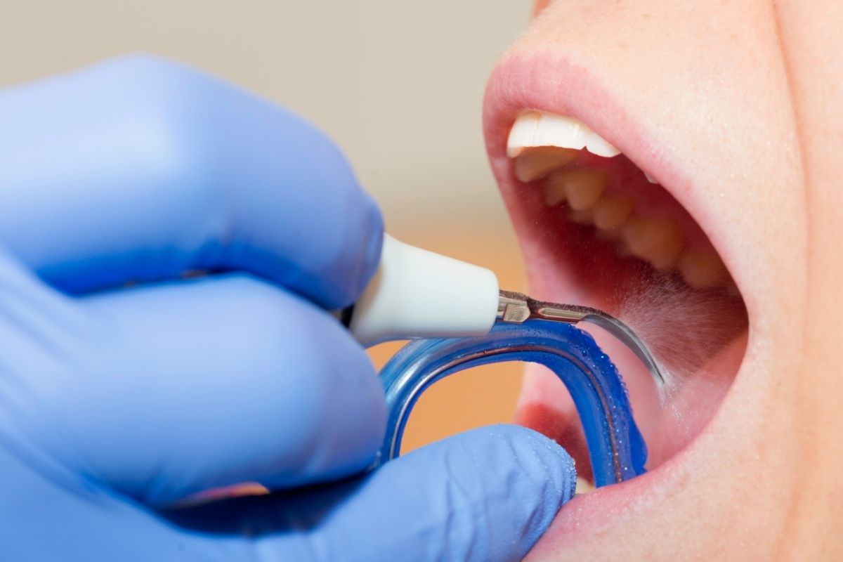 Teeth Cleaning in Navrangpura Ahmedabad